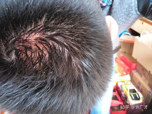 头皮有红点红疙瘩是咋了