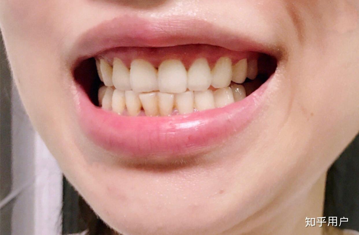 为什么牙齿总是很黄？ - 知乎