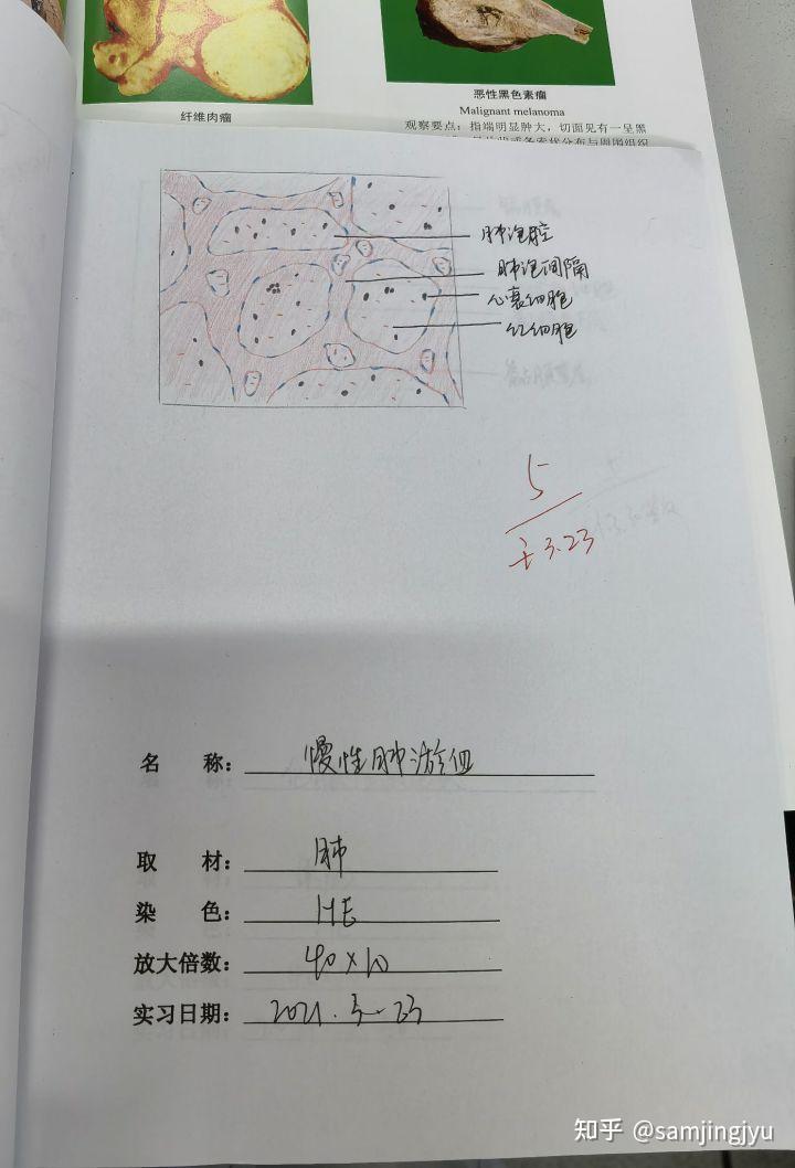 2.慢性肺淤血1.肝细胞脂肪变性178 人赞同了该文章samjingjyu