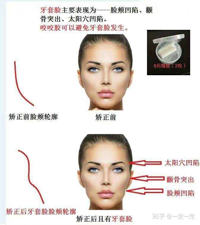 牙套脸 - 知乎