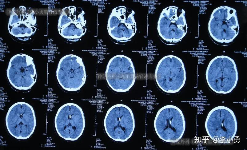 后枕小脑脊膜膨出术后仍脑积水,脑分流术后颅内感染性顽固头痛性昏迷