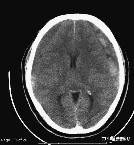 正常大脑的CT片图片
