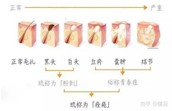 粉刺黑头闭口区分 v2-a8f51572e9f5a8a8aa631d3202e1cc65_r.jpg