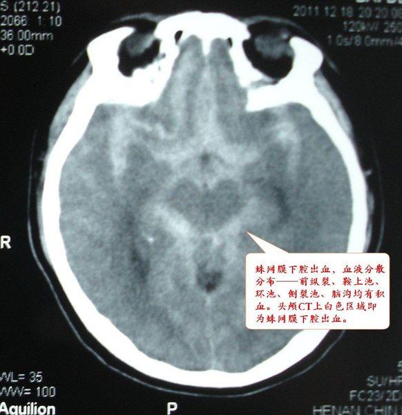 深入大脑,讲讲蛛网膜下腔出血 