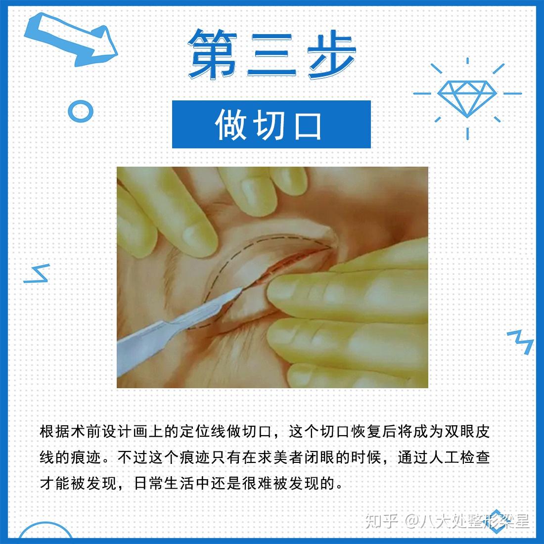 爱美者不了解全切双眼皮过程,只是因为没有看过切开双眼皮的过程图解