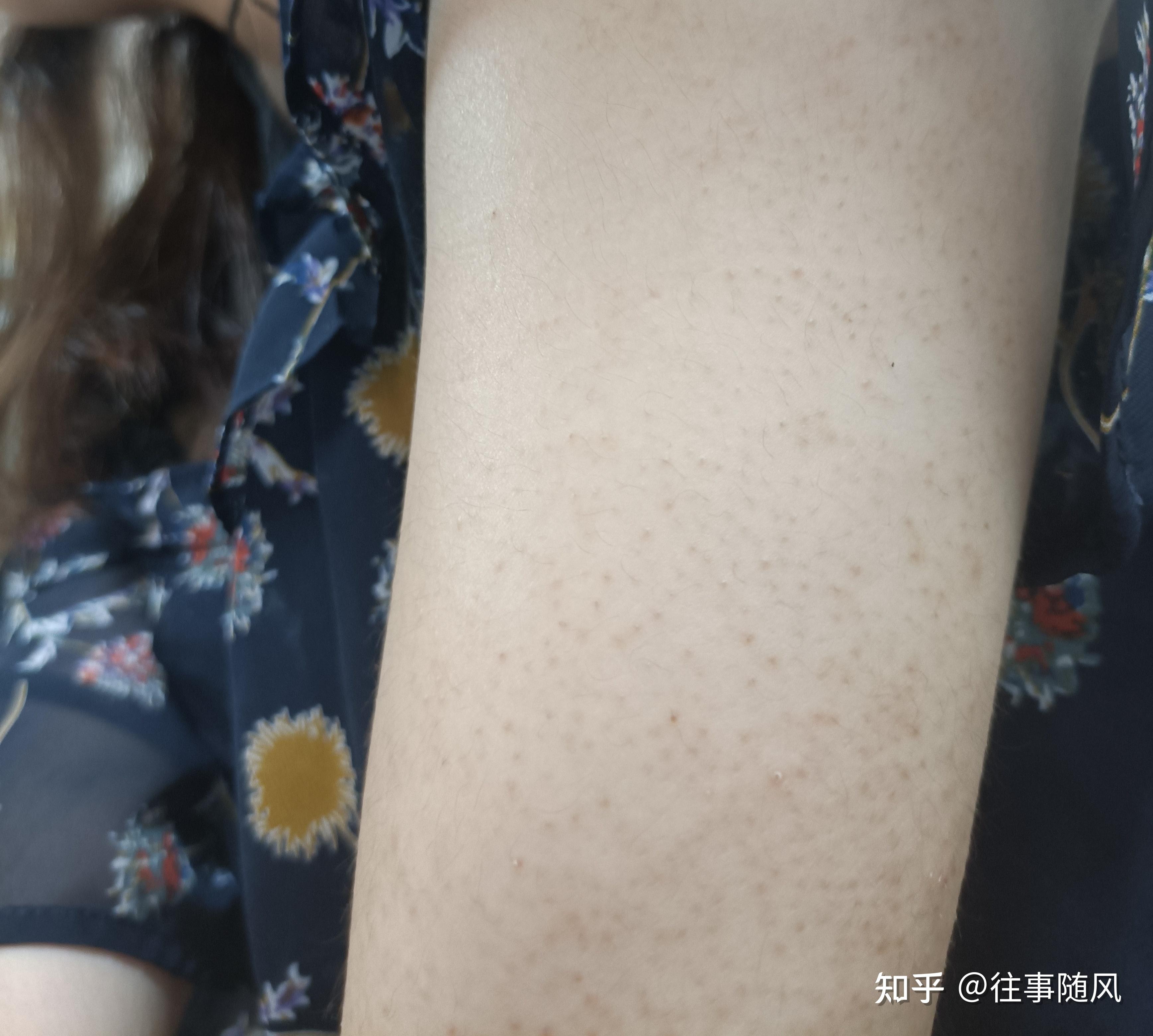 磨砂膏+润肤乳去鸡皮试验 - 知乎