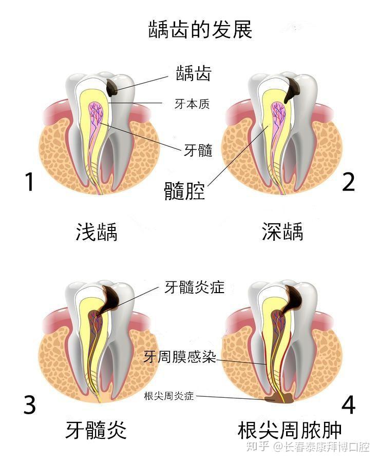 得了龋齿,什么情况可以直接补牙,什么情况又需要做根管治疗? 