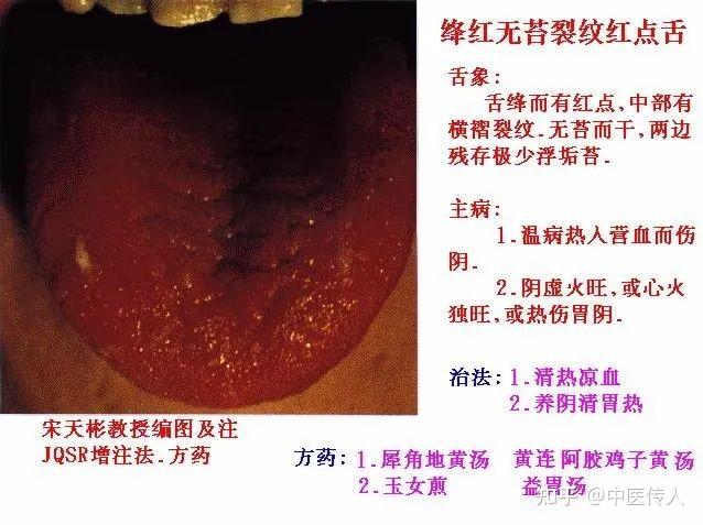高清舌诊图解：各种临床证型舌象图谱大开眼界 - 知乎