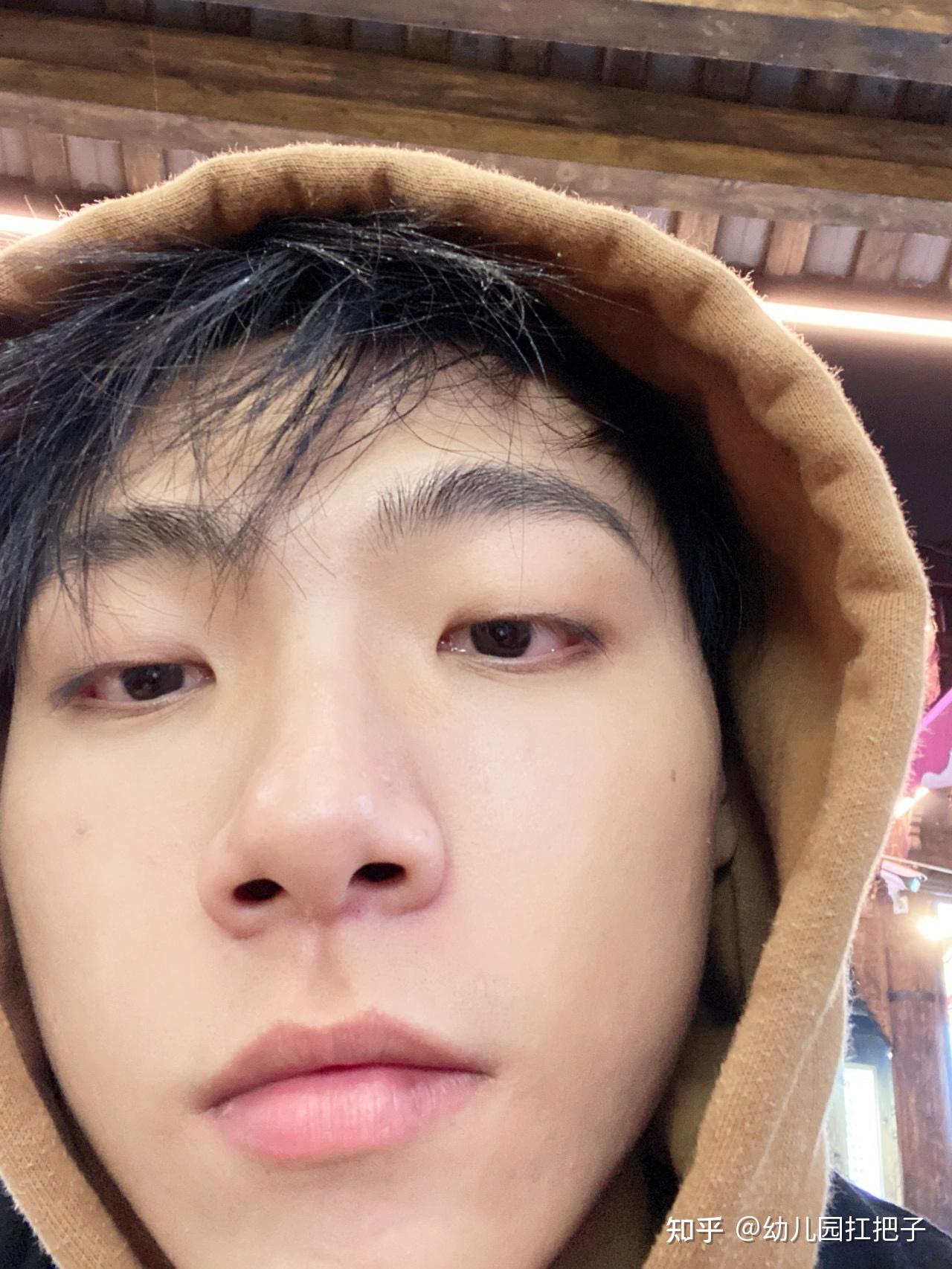 就哥这一脸痘,咋的不能评上个"二级伤残",那就是检测机器瞎了眼一看这