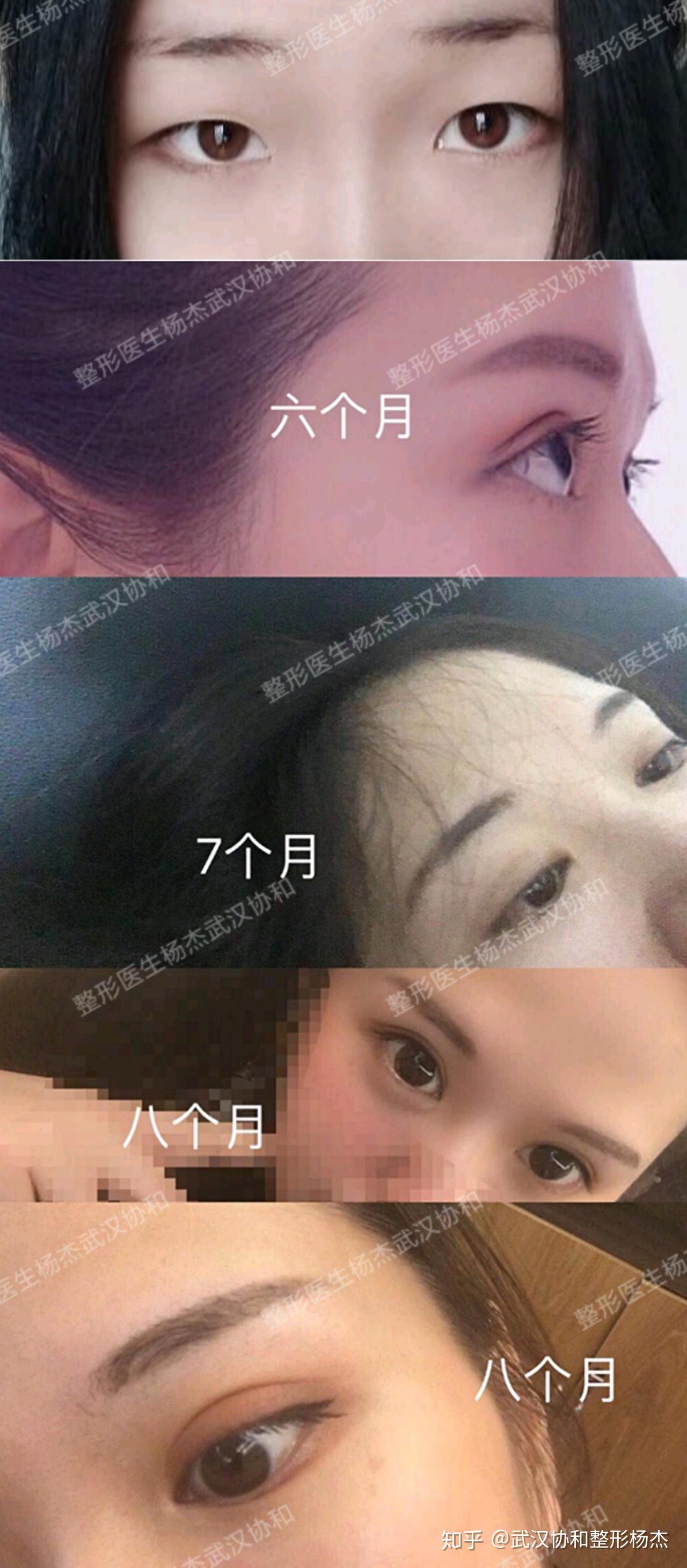 眉骨和眶骨有落差就一定适合欧式大双眼皮吗