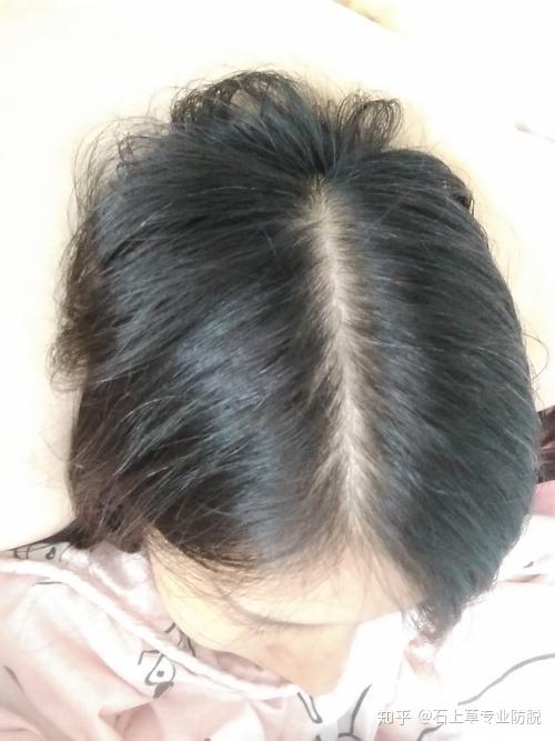 什么办法可以生发 v2-a95ee488e43e0089e392010d662192e5_r.jpg