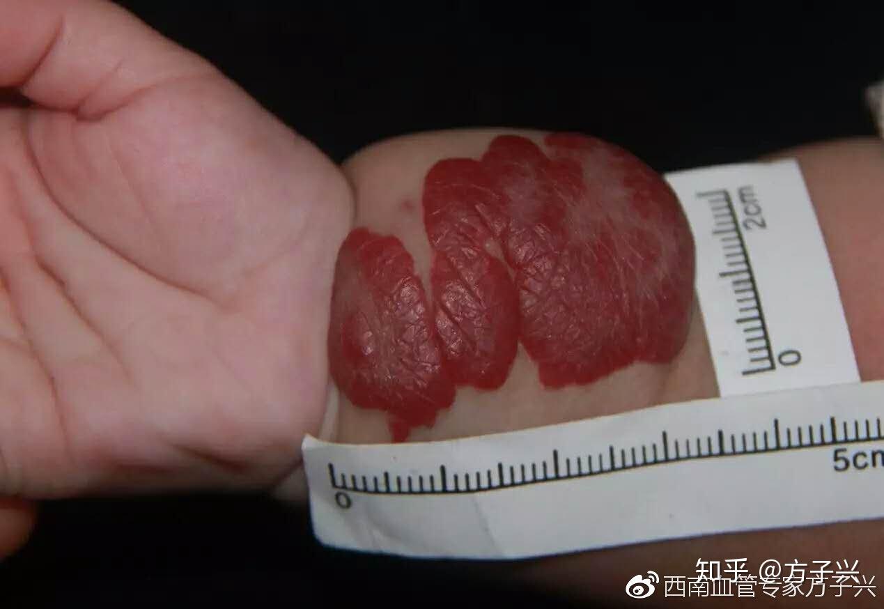 这不是胎记父母的忧心事婴幼儿血管瘤