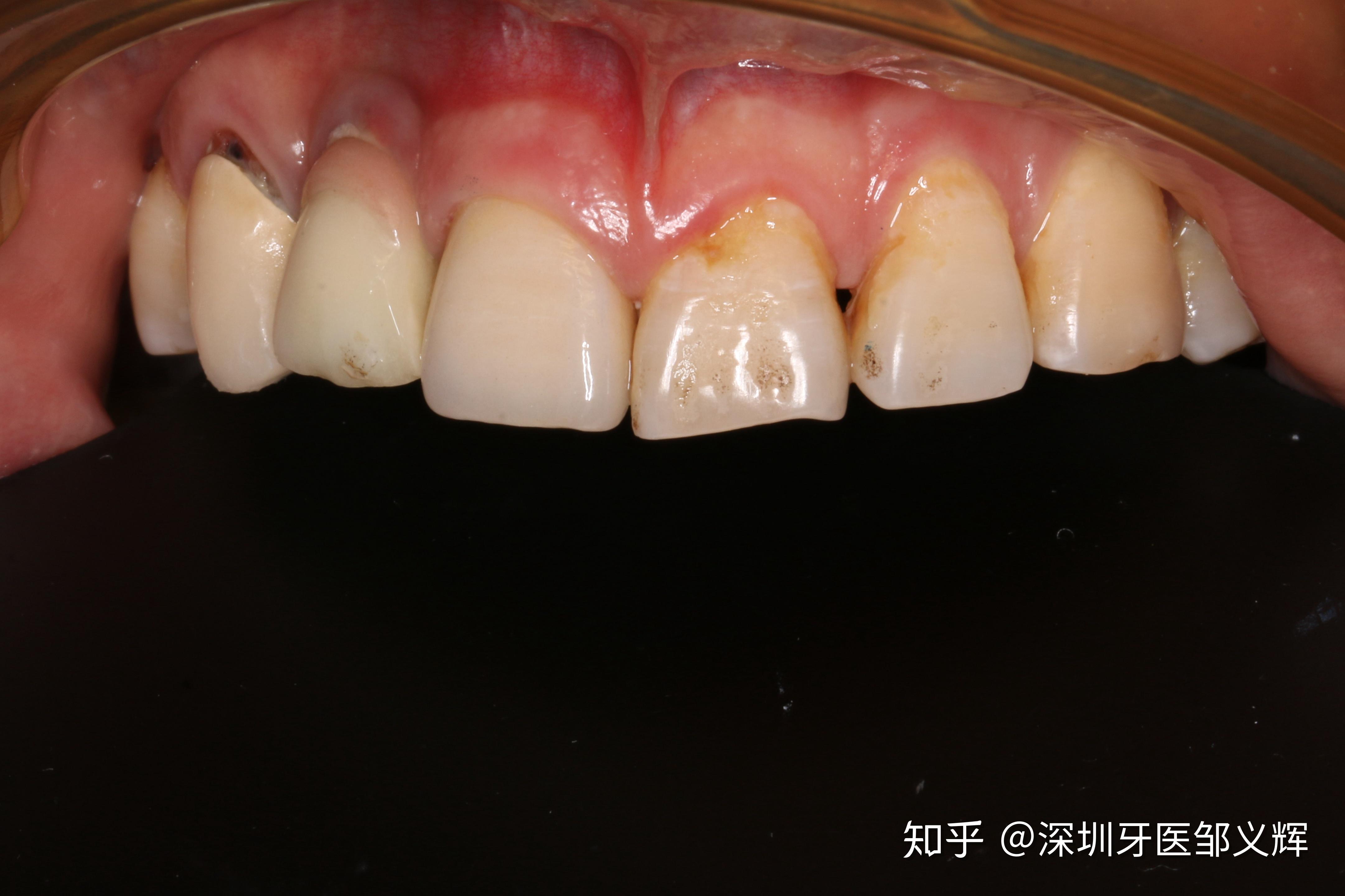 前牙折断氧化锆桩全瓷冠修复一例