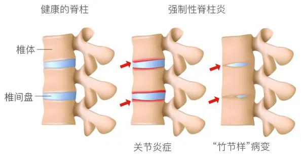 强直性脊柱炎会遗传吗图片