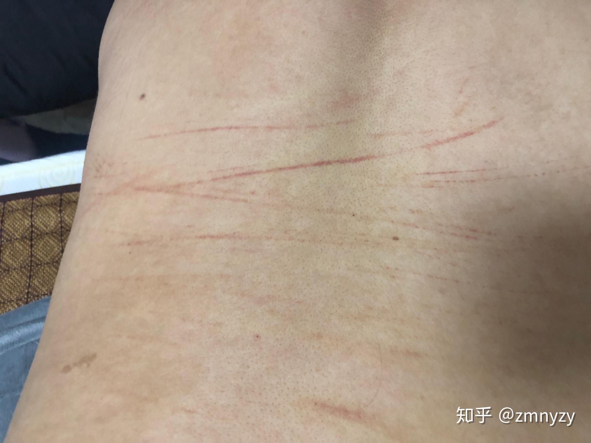 男朋友背上有抓痕不是我抓的不是他抓的据他所说也不是其他女人抓的