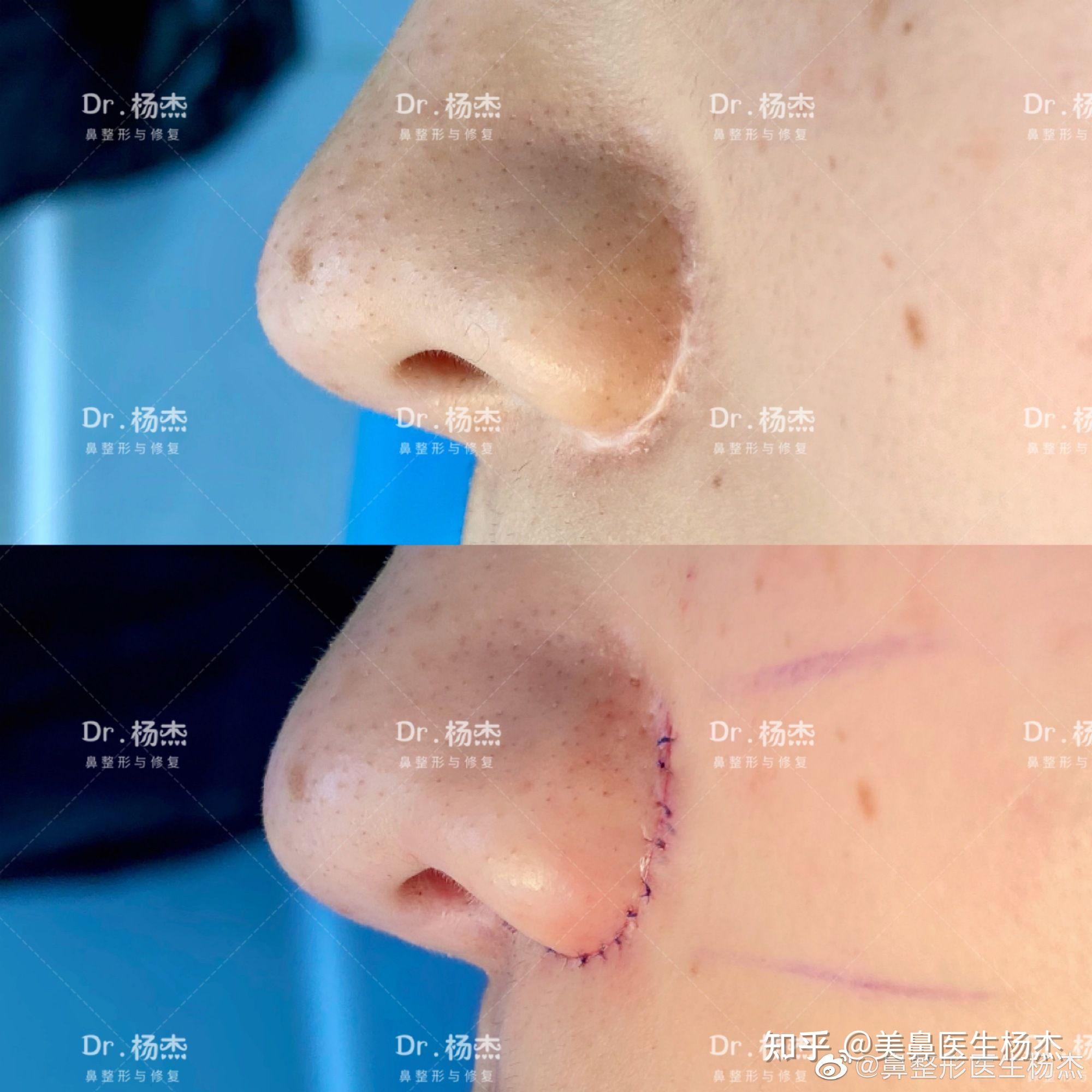 鼻翼缩小疤痕修复切除