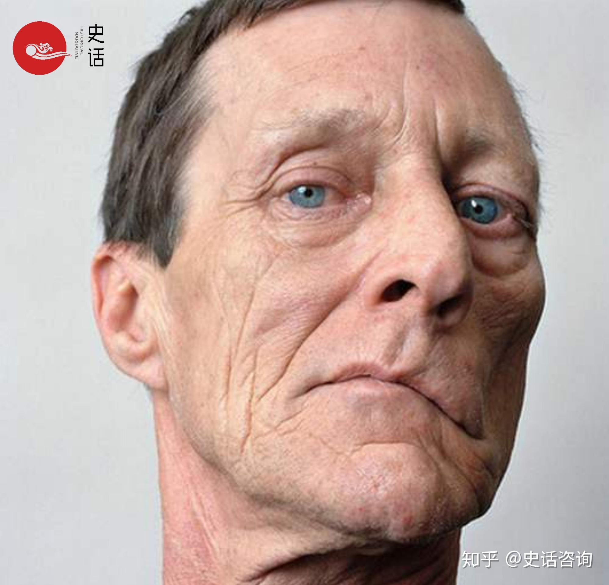 面神经炎,俗称面神经麻痹(即面神经瘫痪),"吊线风",是以面部表情肌群