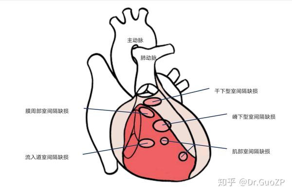 聊聊先天性心脏病——室间隔缺损