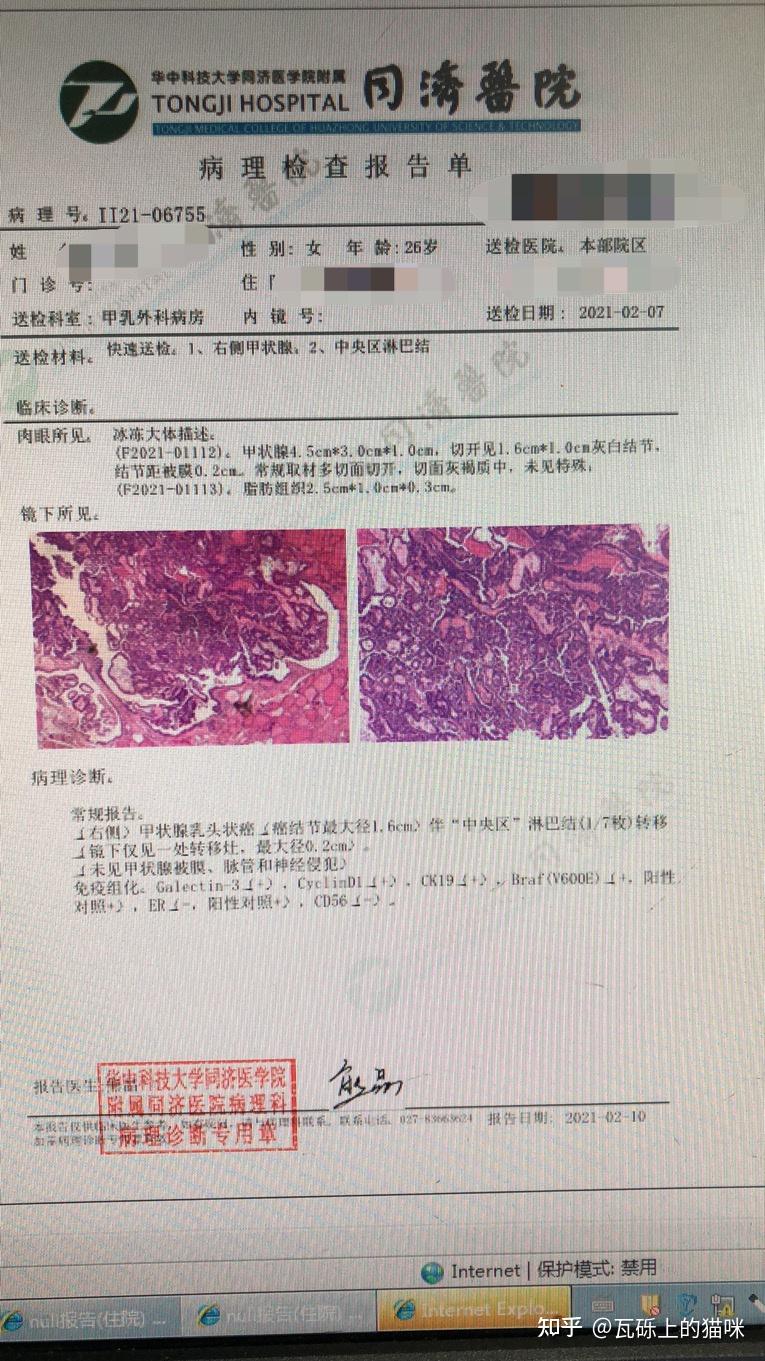 女,26歲,甲狀腺乳頭狀癌 - 知乎