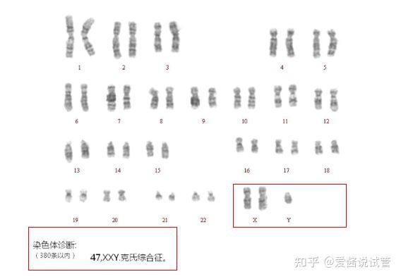 XXY染色体人的特征图片