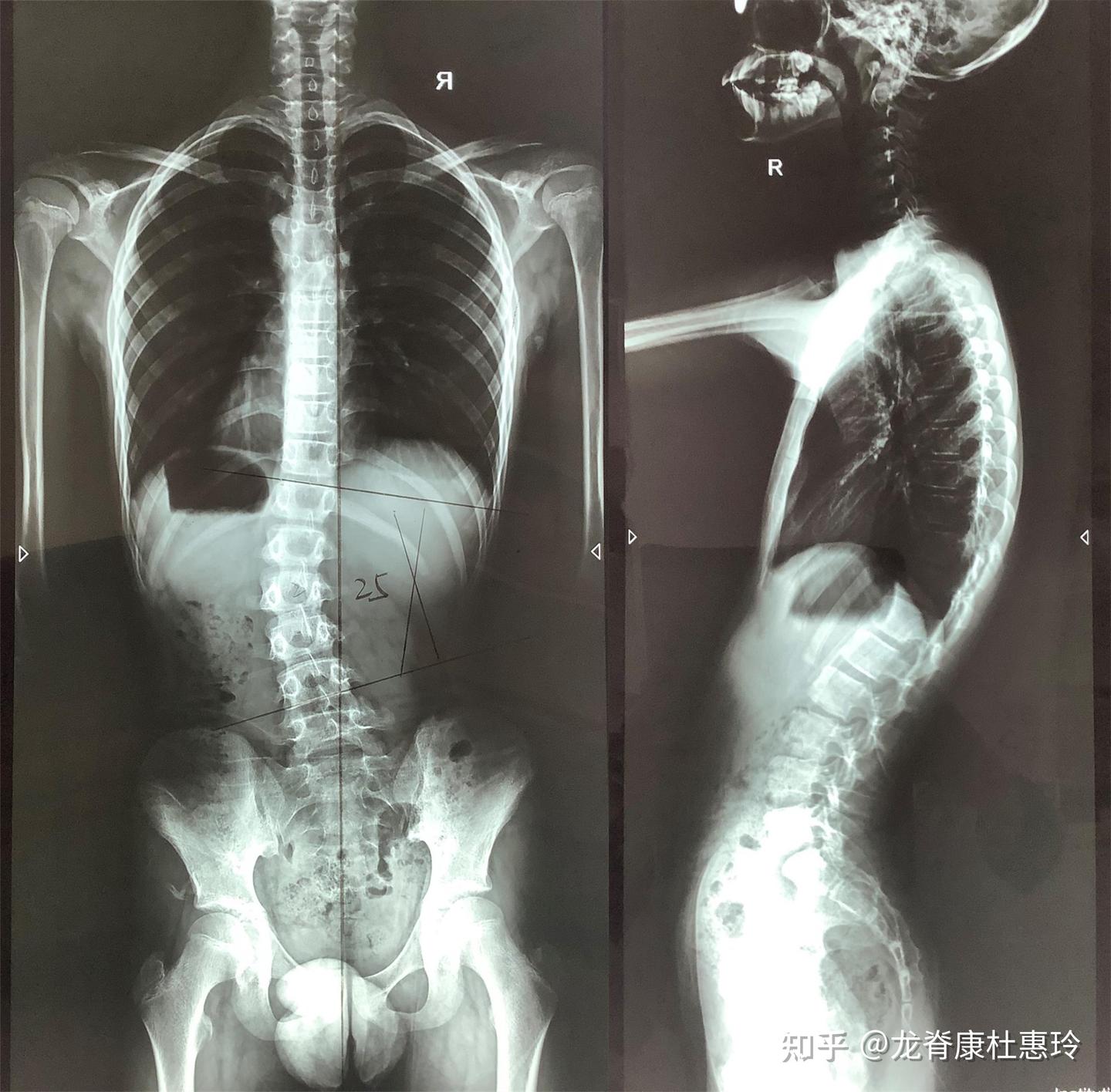 10岁侧弯男孩,治疗1个月后剃刀背减少了6°! - 知乎