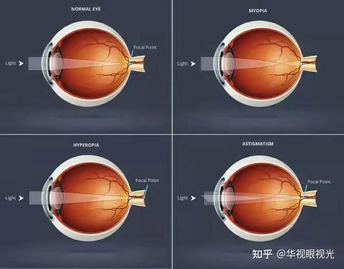 什么是屈光不正常见屈光不正有几种