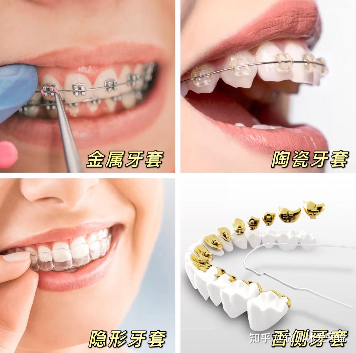 广州牙齿矫正医院怎么找求推荐的口腔医院牙齿矫正价格片切拔牙正畸