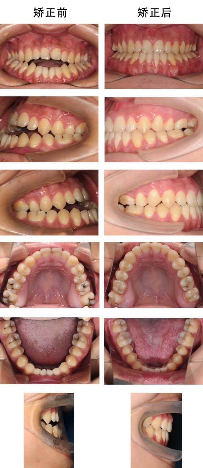 牙缝大的症状是选择牙齿矫正还是牙齿贴面比较好