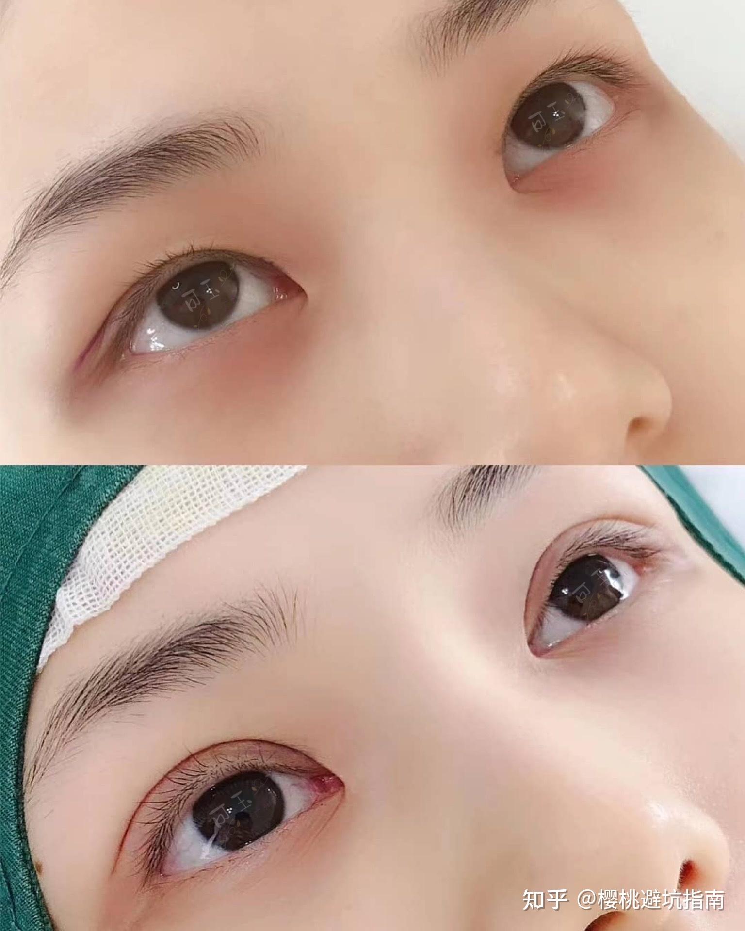 广州割双眼皮眼综合医院医生推荐广州埋线全切双眼皮哪家好双眼皮修复