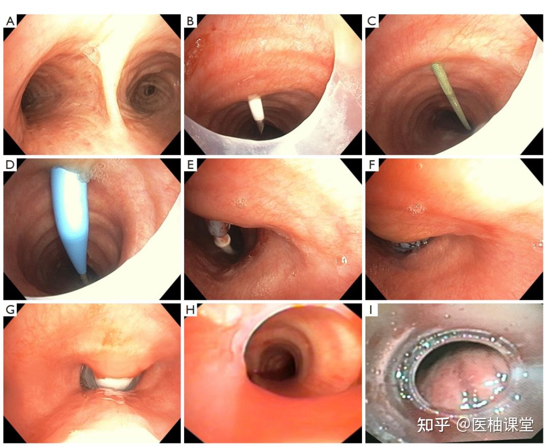 icu的经皮气管切开术