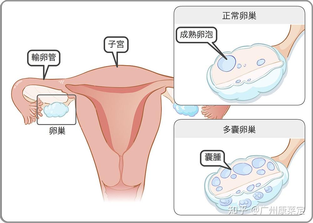 3,多囊卵巢,单侧或双侧有大于或等于12个小卵泡