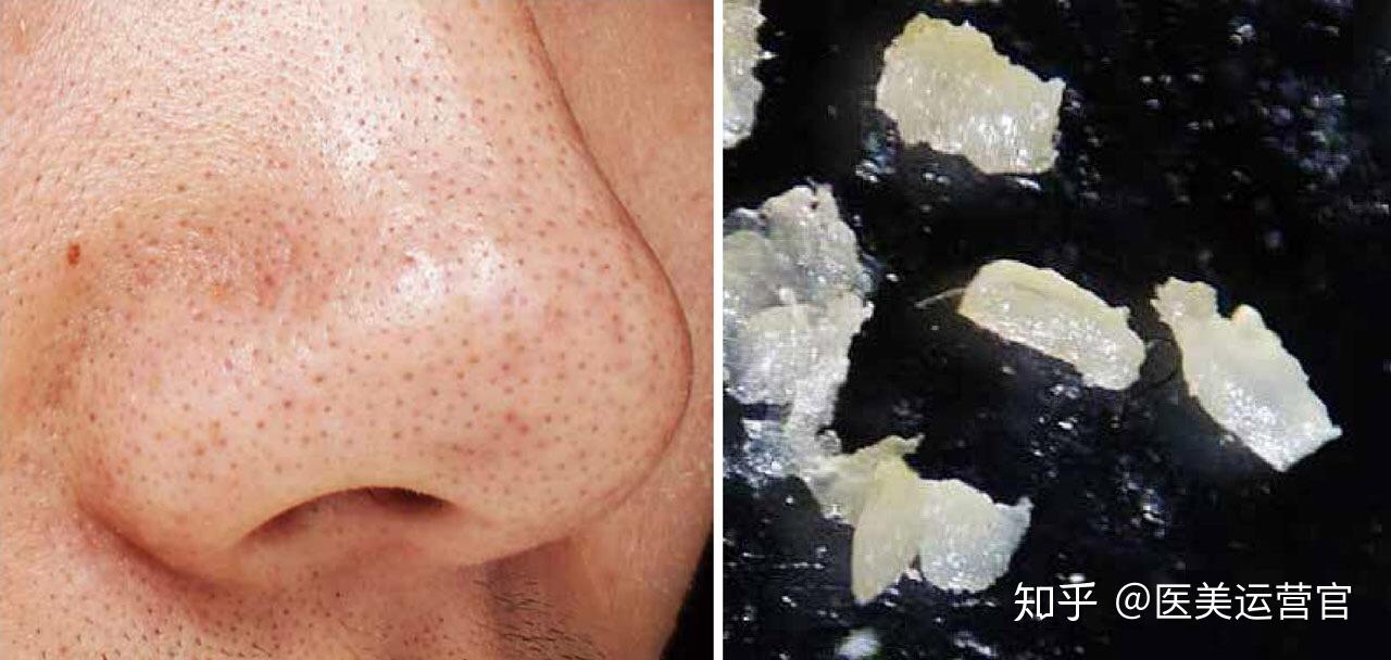 黑头白头护理三部曲