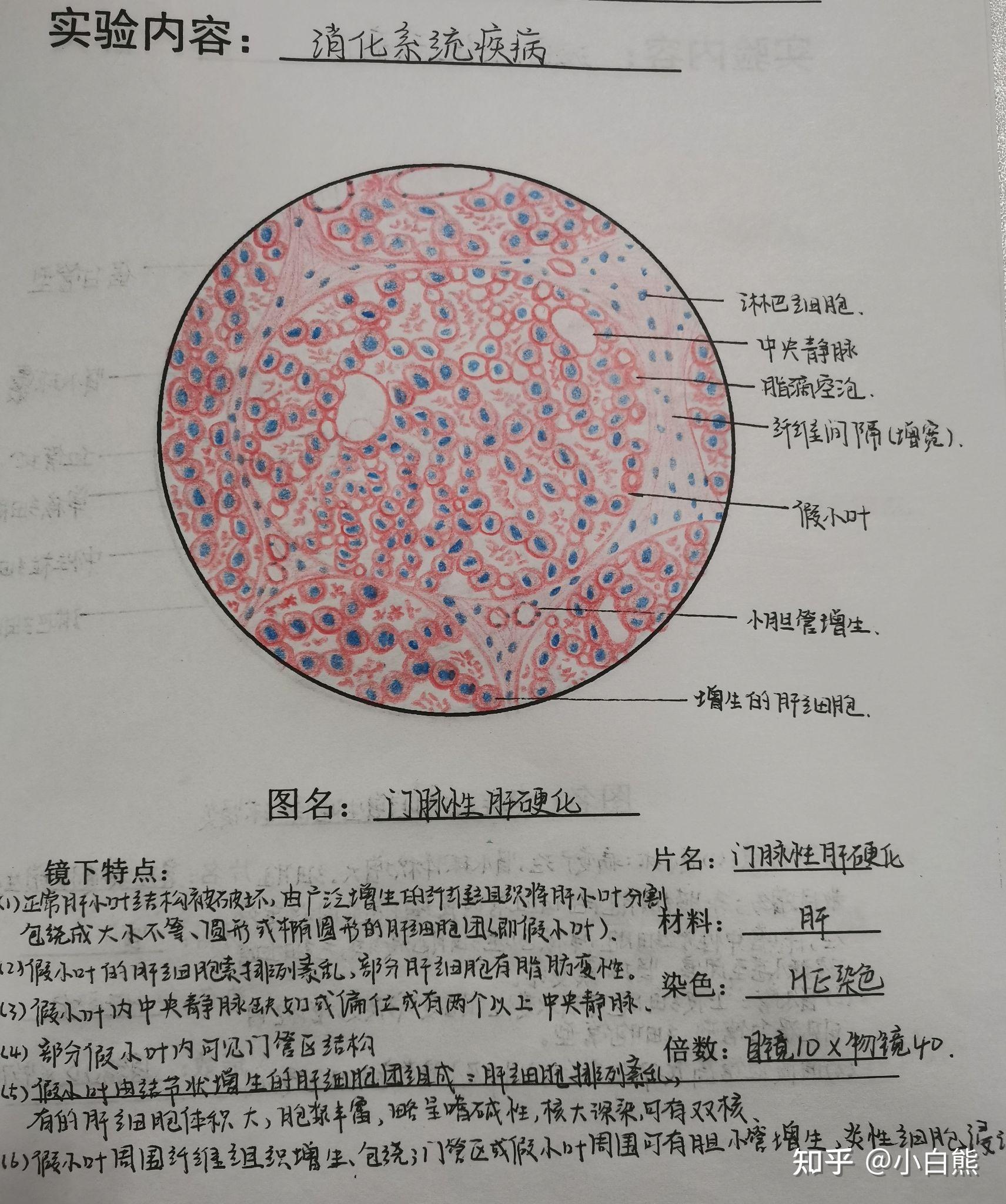 慢性肝淤血切片手绘图图片