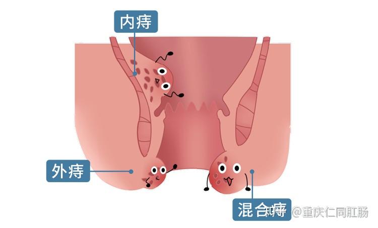 混合痔——结合了内痔和外痔的特点;外痔——痔核长在肛门口内侧附近