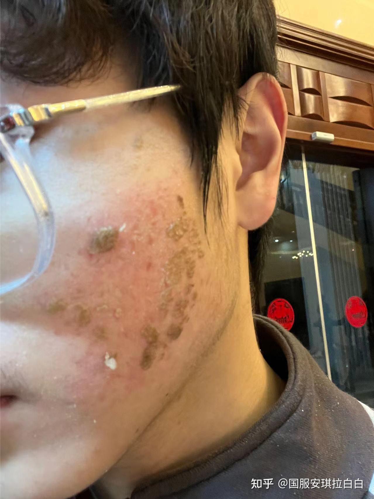 上海华山医院点阵激光记录1至35天