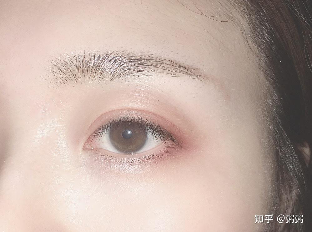 郑州双眼皮自然款四个月分享