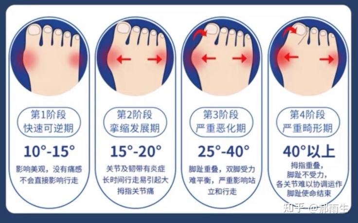 拇外翻的症状表现有哪些 - 知乎