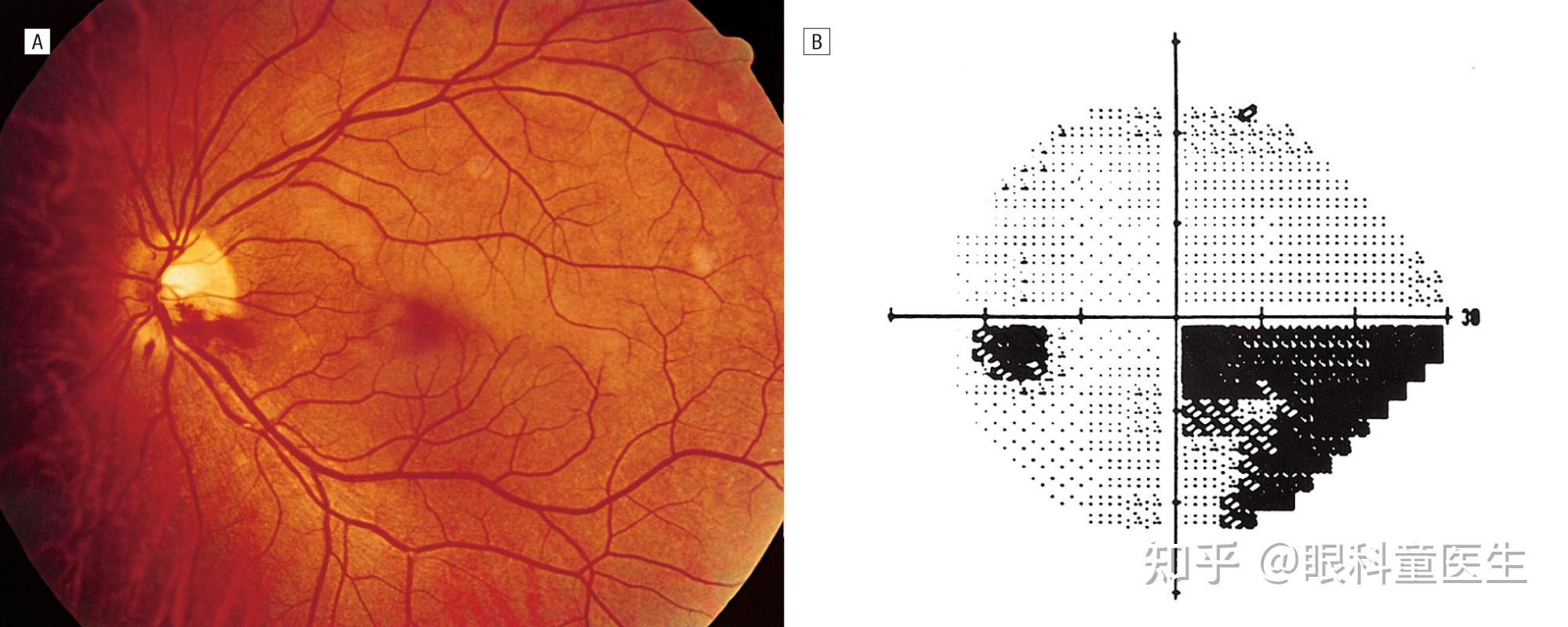 视网膜血管性疾病2视网膜动脉阻塞