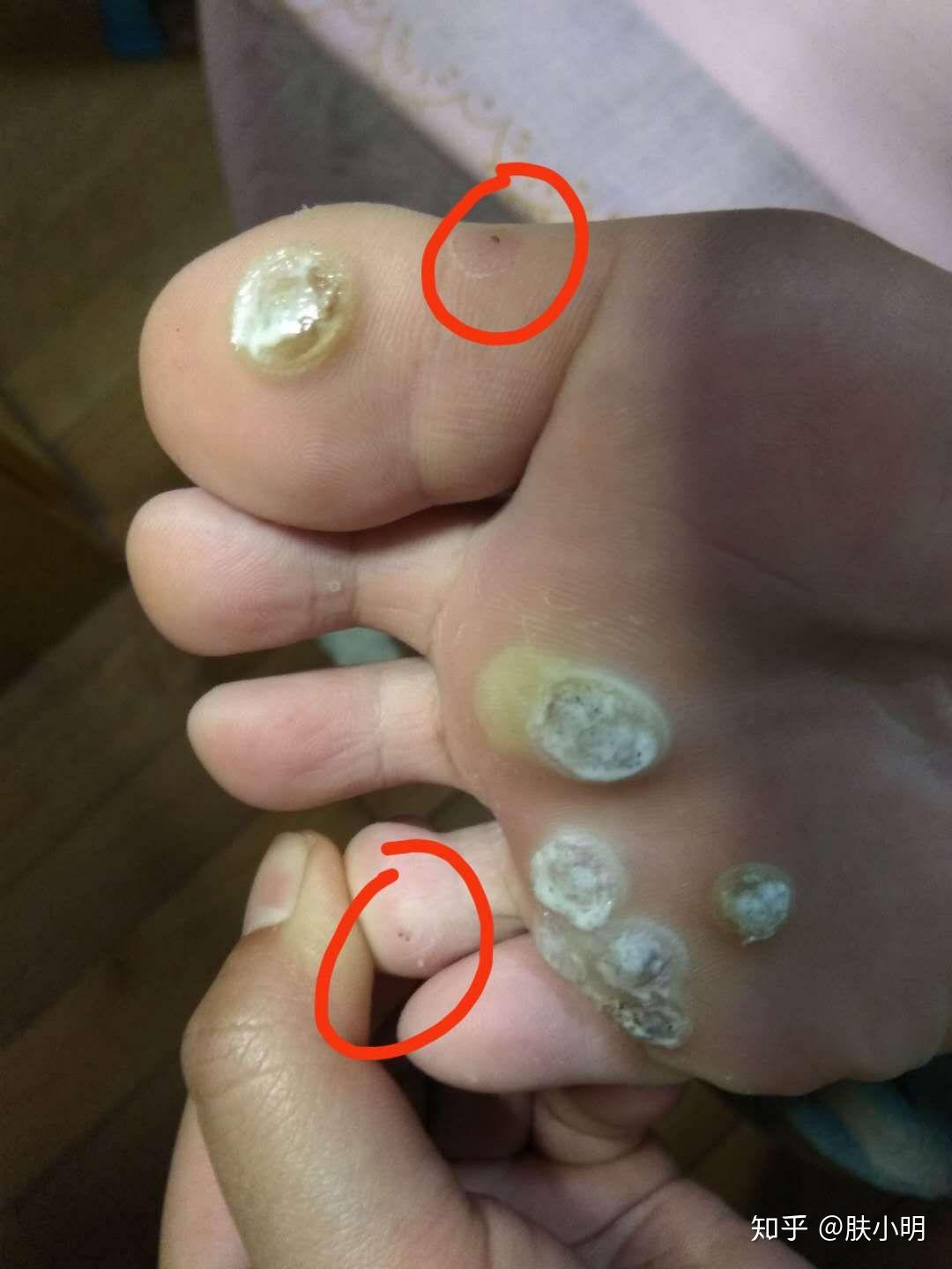 脚上长了可多洞洞不知道是鸡眼还是什么不痛不痒的