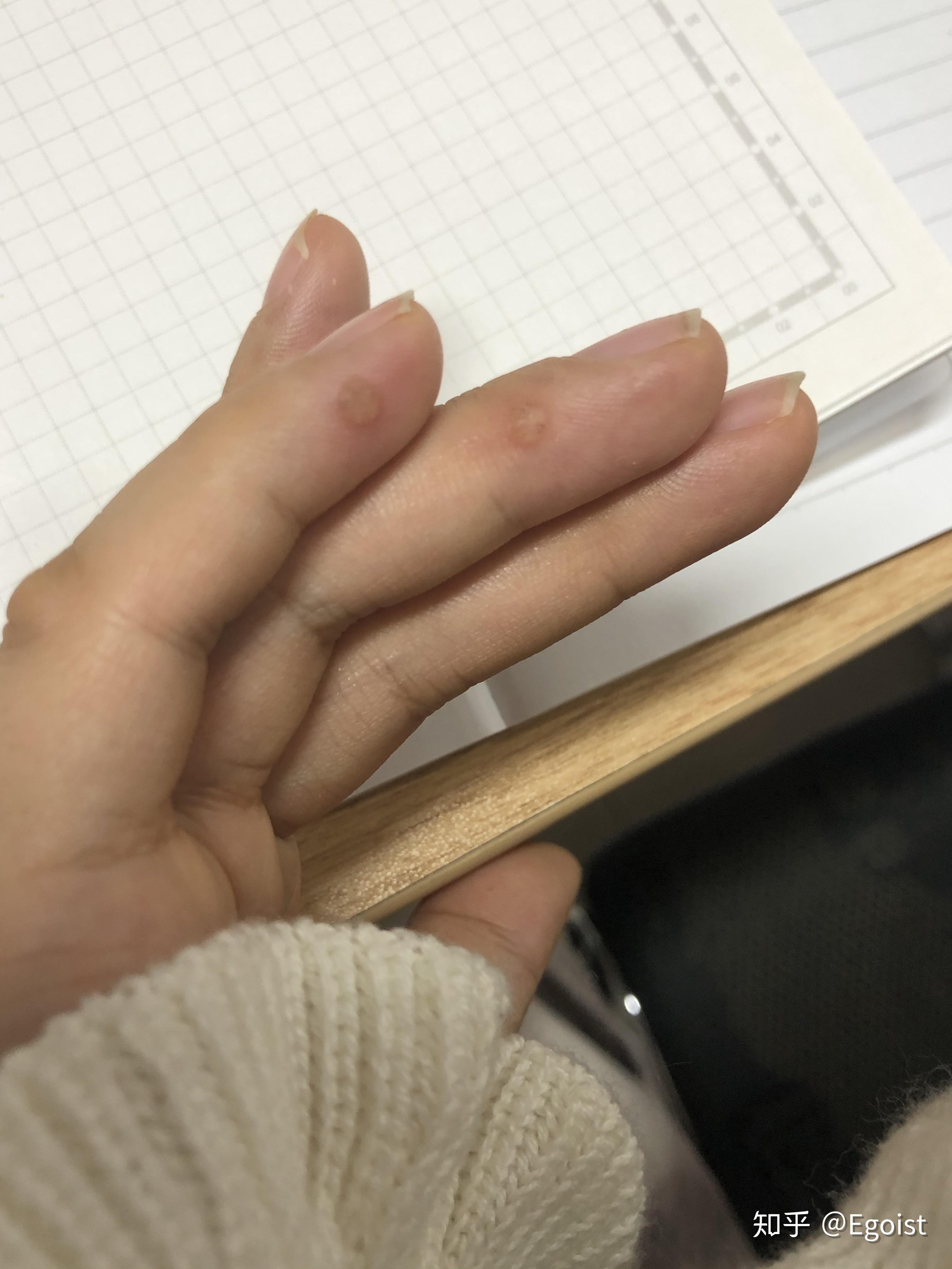 用大蒜去除瘊子的过程记录贴