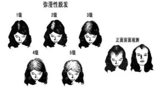 雄激素性秃发人群庞大,当代年轻人该如何正确防治? - 知乎