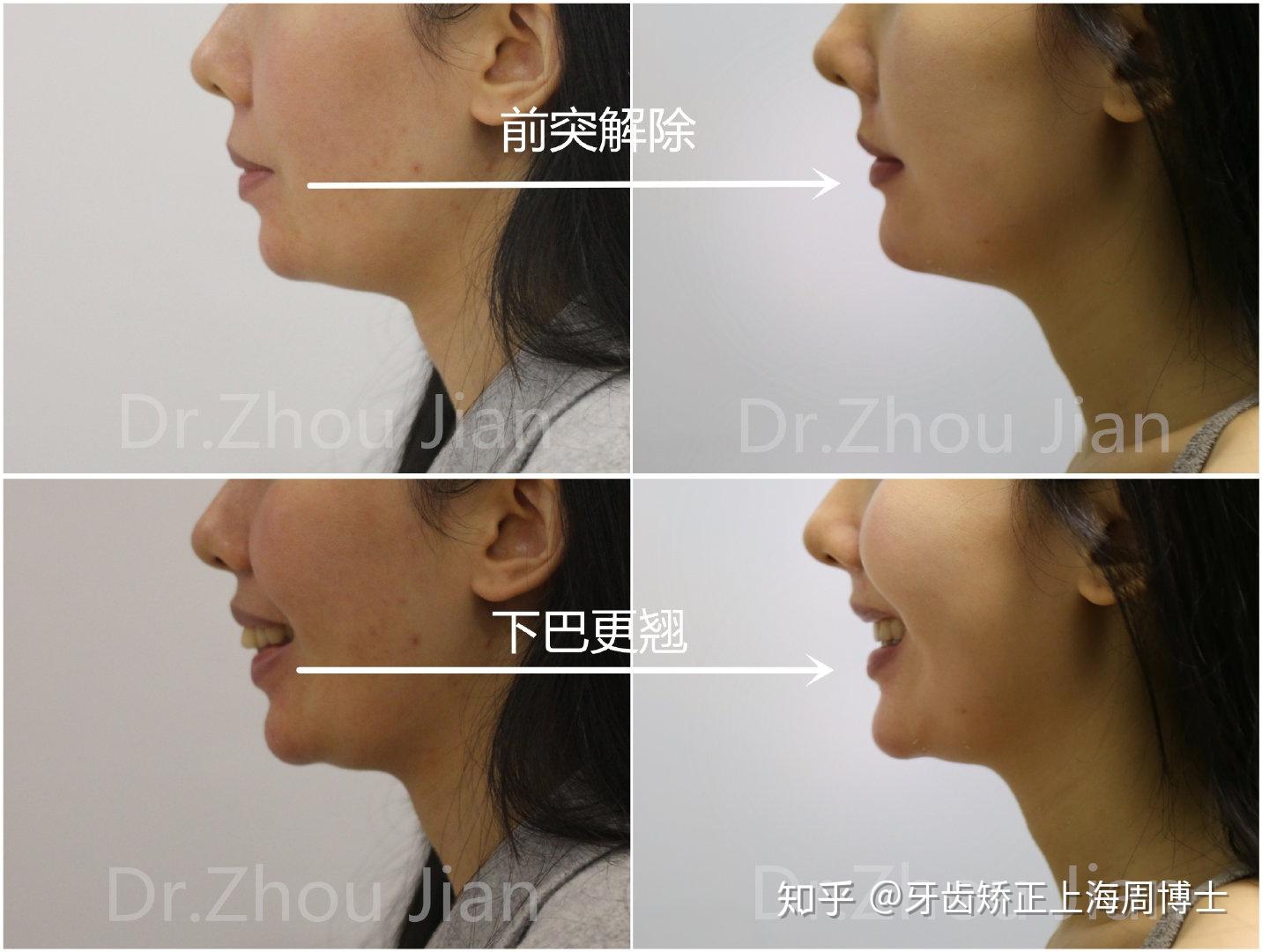 下巴矫正器图片_下巴矫正器_下巴矫正