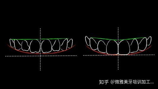 什麼是牙齒美學設計