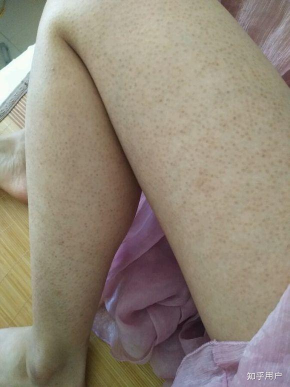 怎么样能去了鸡皮肤(有没有去鸡皮肤的方法)