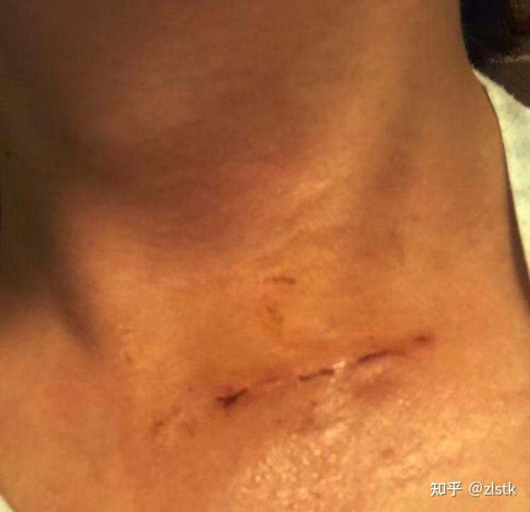 24岁成人肌性斜颈手术及疤痕记录 - 知乎