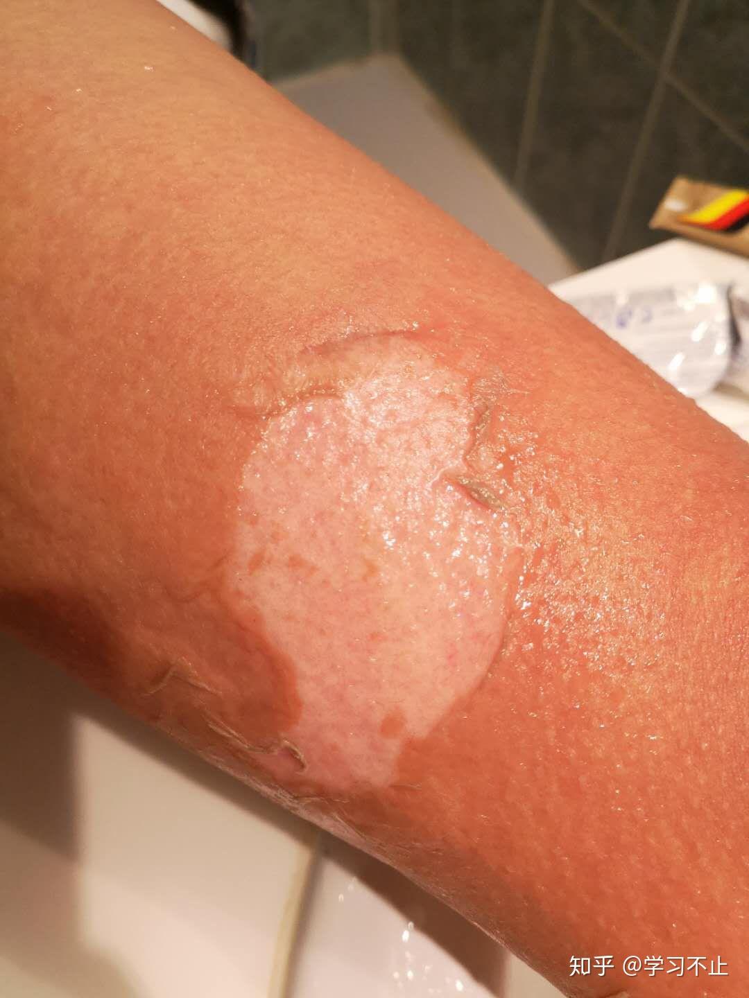 巴黎烫伤脱皮记