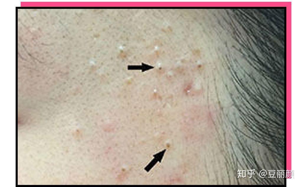 开口和闭口粉刺的区别