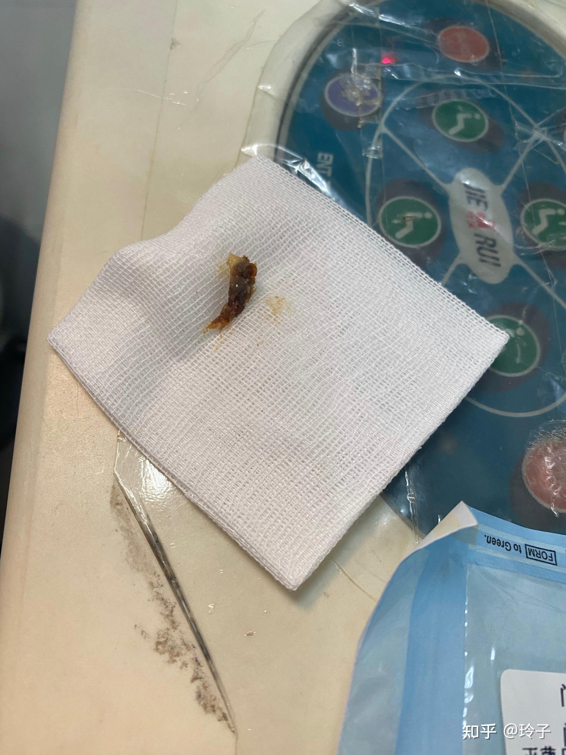 3岁女宝耳朵的耳屎堵住怎样清理