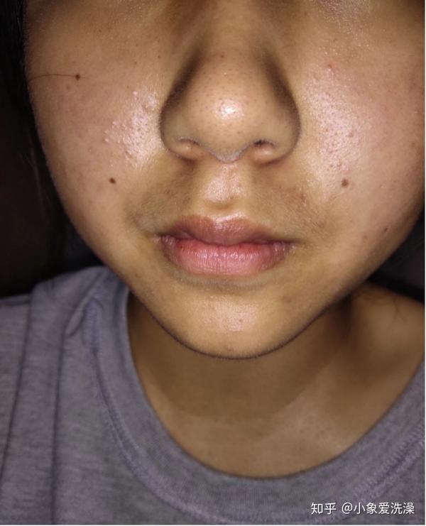 去黑头最全干货攻略 让你告别 草莓头 知乎
