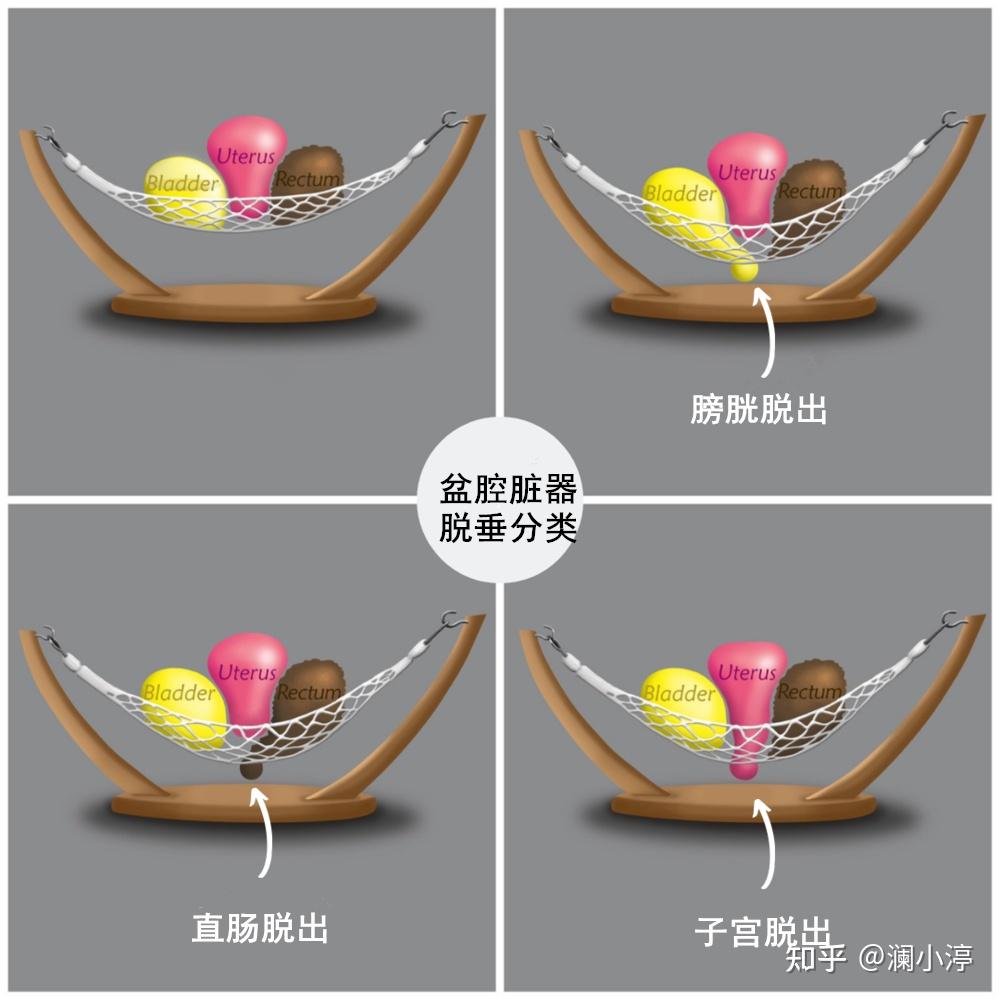 盆腔脏器脱垂到底多严重还看popq分度